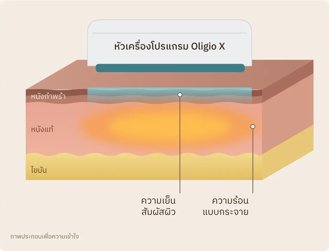 เครื่องโปรแกรม Oligio X ที่ The Hazel Clinic