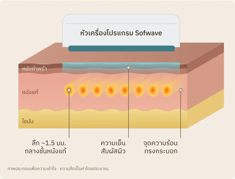 ภาพชั้นผิว: โปรแกรม Sofwave ส่งความร้อนไปที่ชั้นหนังแท้ ลึกประมาณ 1.5 มม. เหนือชั้นไขมัน